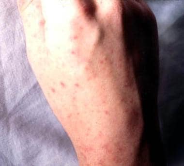 Nonspecific Skin Rash  Saint Luke's Health System