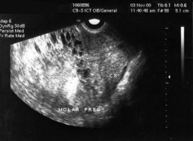 Pathophysiology Of H Mole Pregnancy