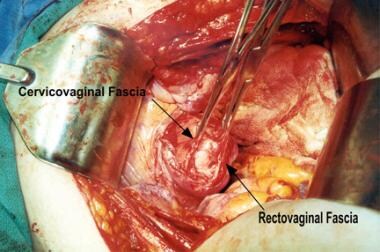 Uterine Prolapse in Emergency Medicine: Background, Pathophysiology,  Etiology