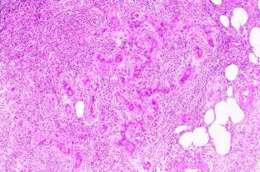 A section of a rare lymph node metastasis from ade
