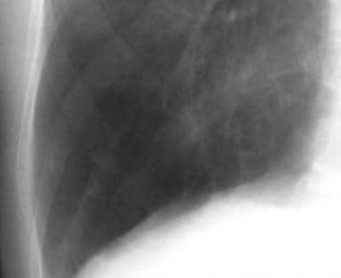 Close-up chest radiograph of the right lower zone 