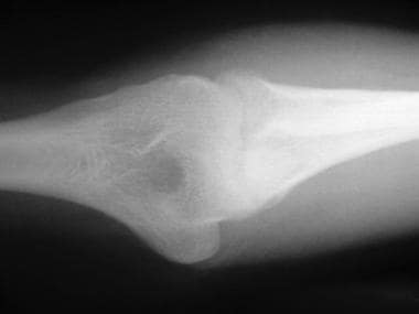 Osteoarthritis of the elbow is not commonly seen; 