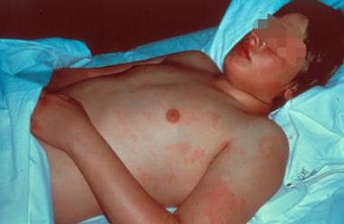 Erythema marginatum, the characteristic rash of ac