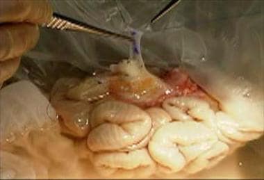Intestinal transplantation: Back table operation w