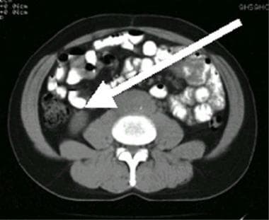 CT扫描，右侧输尿管扩张，无静脉注射