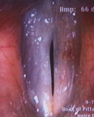 Videostroboscopy of postoperative vocal fold polyp