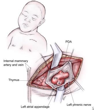 Pulmonary Artery Banding. The left anterior thorac