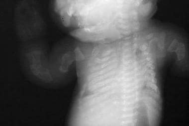 Beaded ribs. Multiple fractures are seen in the lo
