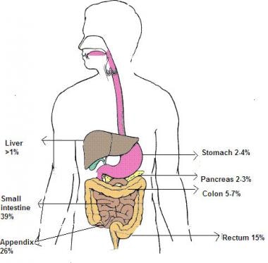 Distribution of carcinoid tumors. 