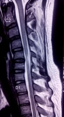 T2-weighted cervical spine MRI of a patient with H