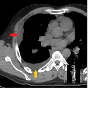 A case of early right pleural malignant mesothelio