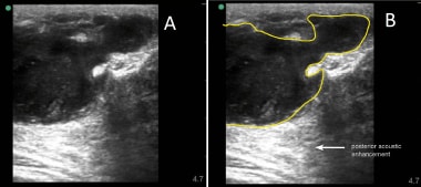 Loculated breast abscess. A) A large loculated abs