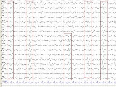 EEG in Dementia and Encephalopathy: Overview, Dementia, Vascular Dementia