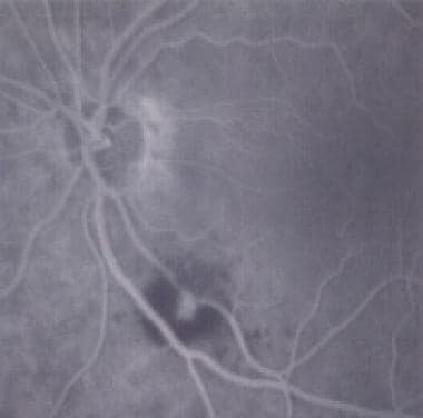 Fluorescein angiogram during the late phase showin