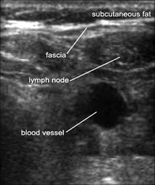 Ultrasound image of a blood vessel lying deep to a