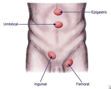 Variations of hernia type and location. 