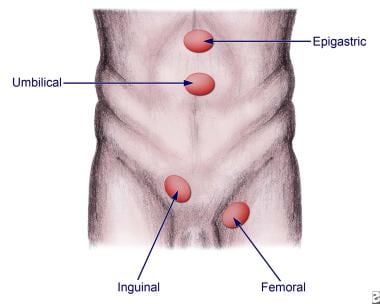 Hernia Reduction: Background, Indications, Contraindications