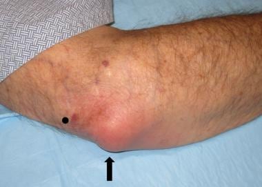 infected olecranon bursitis