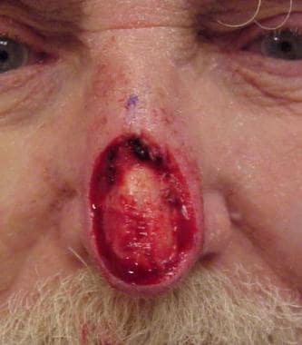A large surgical wound of the nasal tip and suprat