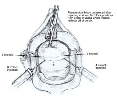 Paracervical block.