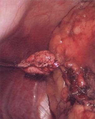 Ligated tail of the pancreas. 