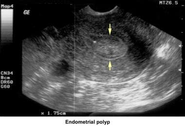Infertility. Endometrial polyp. Image courtesy of 