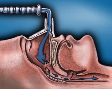 Breathing-related sleep disorder. Lateral cross-se