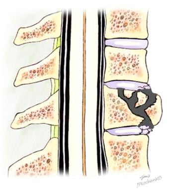 Guiding Your Patient Through Vertebral Compression Fracture Treatment