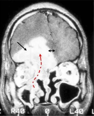 Brain abscess. Gadolinium-enhanced coronal T1-weig
