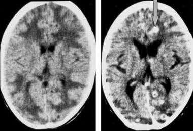 Nonenhanced (left) and enhanced (right) CT images 