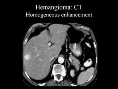 Contrast-enhanced computed tomography (CT) scan th