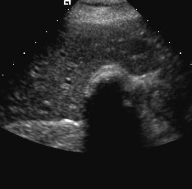 Formation of an echo–shadow complex.