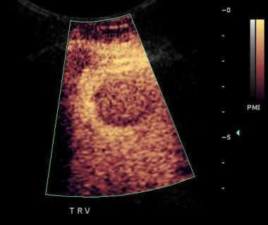 Contrast-enhanced scan of liver: metastatic adenoc