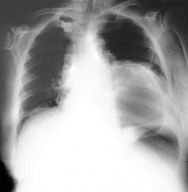 A chest radiograph in a patient with a huge air-fi
