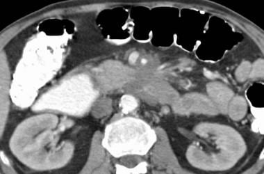 Mesenteric ischemia. CT scan in a 59-year-old man 