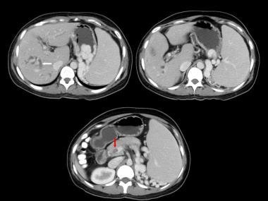 Axial contrast-enhanced CT images of the liver dep