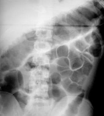 Plain abdominal radiograph that shows distention o