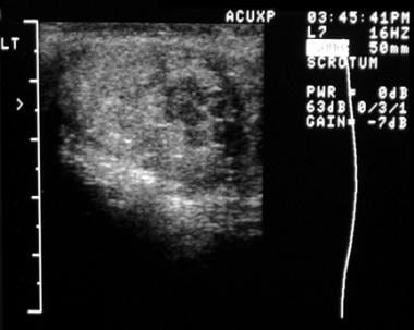 Longitudinal ultrasonogram of the left testis reve