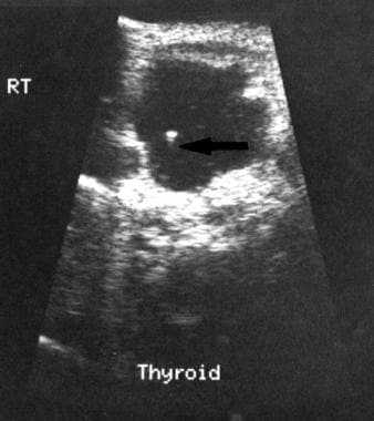 Sonogram demonstrates a cystic colloid cyst with a