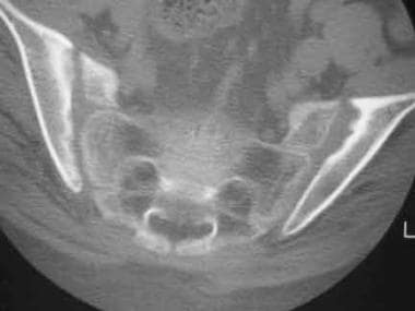 Bilateral sacroiliitis. Axial CT scan shows erosio
