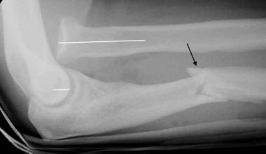 Elbow, fractures and dislocations. Monteggia fract