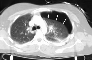 Axial computed tomography image of the chest in a 