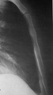 Lateral radiograph of the normal sternum. 