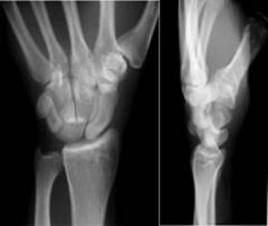 Wrist, perilunate injuries. Dorsipalmar and latera