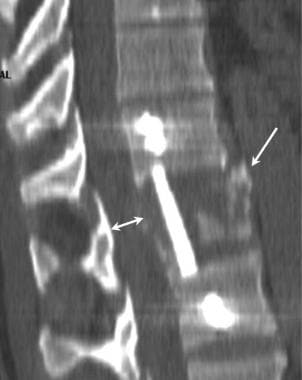 Thoracic spine trauma. Sagittal multiplanar CT ima