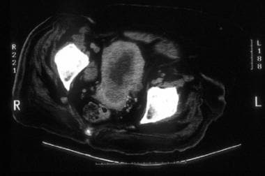 A 73-year-old woman with well-differentiated endom