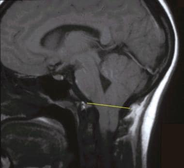 Sagittal T1-weighted magnetic resonance image of t