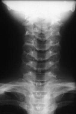 Normal anteroposterior radiograph of the neck. The