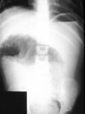 Hirschsprung disease. Plain abdominal radiograph s