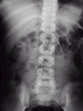 Supine abdominal radiograph shows a mild localized